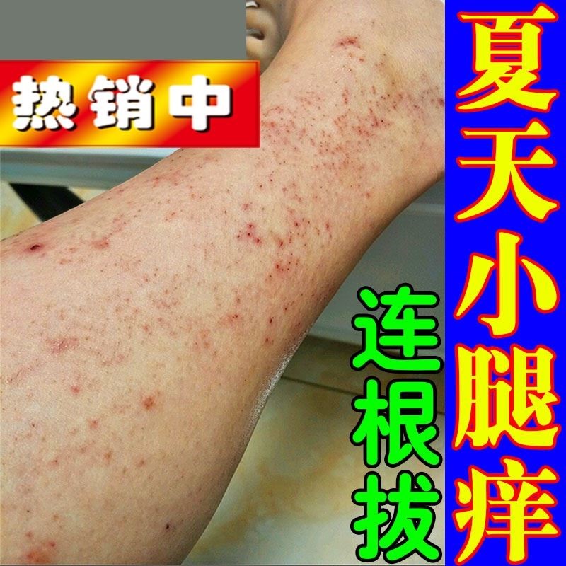 治腿痒的药春夏天热腿窝痒小腿皮肤干燥起皮湿疹腿上起红点过敏药