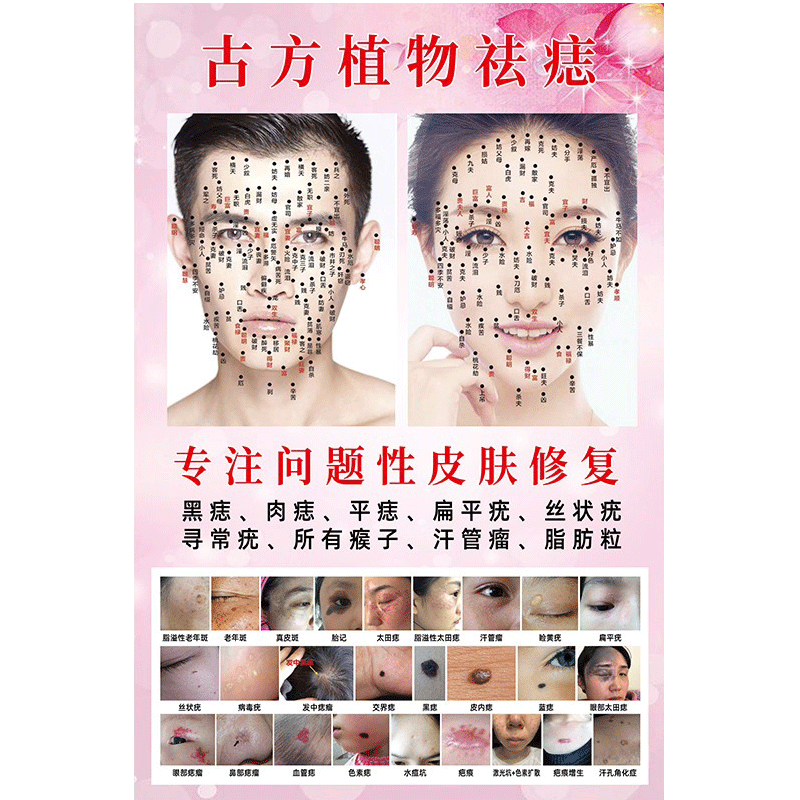 面部点痣图点痣宣传图痣相图取痣祛痣海报男女面痣祛斑点疣广告图