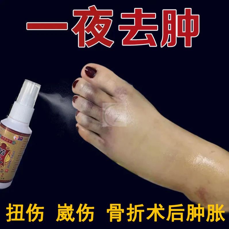 苗王追风液脚踝扭伤手脚消肿止痛活血外用摔伤药膏骨折骨裂恢复药