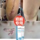 去除增生硬疙瘩胸前凸起修复膏缝针手术凹陷疤痕霜贴刀疤祛凹凸疤