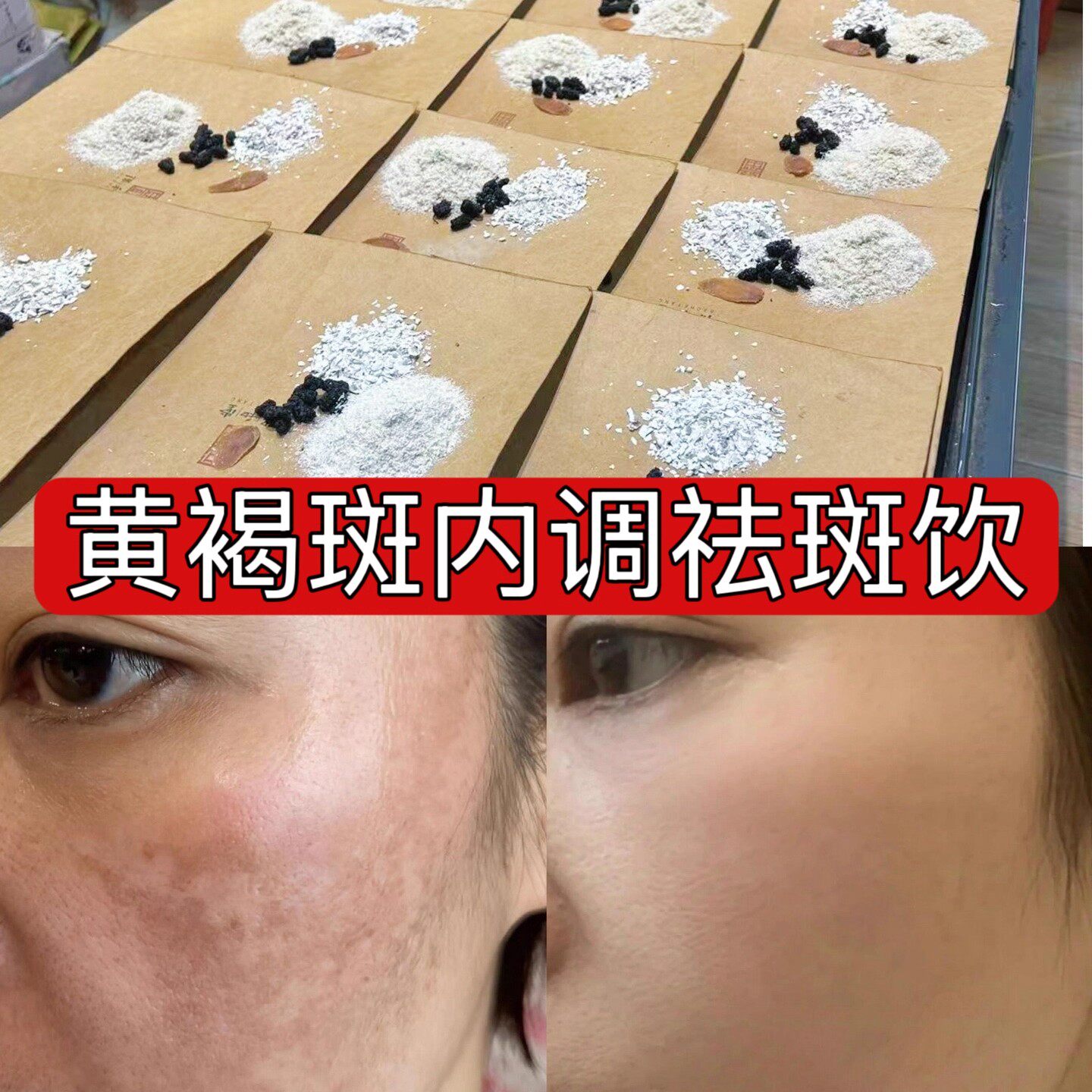 杭州医院【内调祛斑饮】黄褐斑 雀斑 晒斑