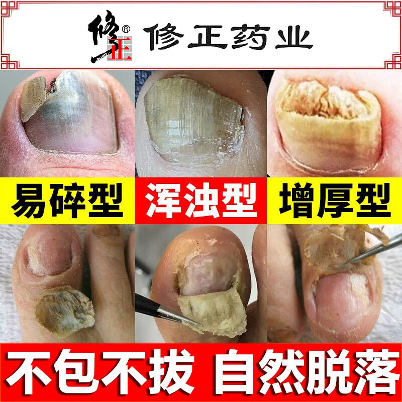 灰指甲液去除增厚抑菌脚趾脱甲膏非根治特效治疗旗舰店药正品专用