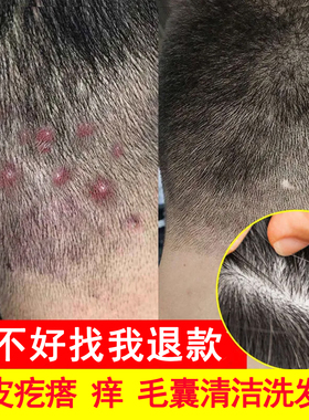 同仁堂 头上长疙瘩痘毛囊炎洗发水深层清洁止痒控油男女士洗发露