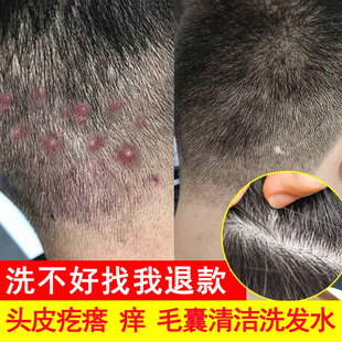 同仁堂 头上长疙瘩痘毛囊炎洗发水深层清洁止痒控油男女士洗发露