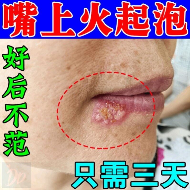 嘴唇疱疹上火起泡烂嘴角口角炎专用药膏干裂脱皮红肿痒修覆膏
