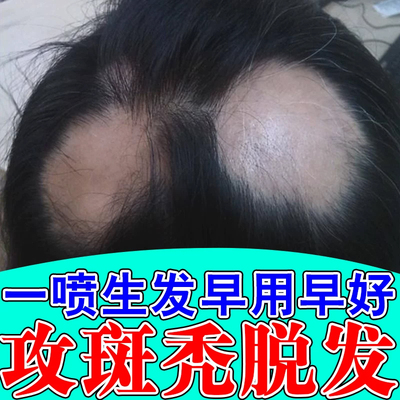 生发固发丸【自营】美国可兰米诺地尔生发液男士生发溢脂性脱