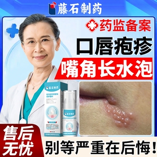 嘴角长水泡口唇疱疹嘴唇单纯疱疹特上火起泡烂嘴角效藤石制药膏EM