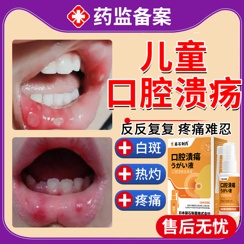 口腔溃疡可搭喷剂碳酸氢钠广西上梨口霉菌素混悬液非婴儿凝用胶EM