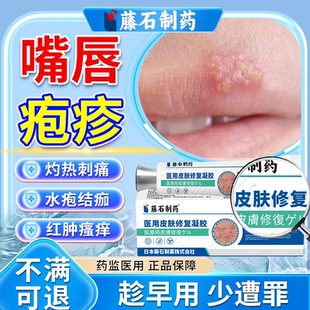 口唇嘴唇疱疹嘴角单纯疱疹特病毒效嘴巴上火起泡烂嘴角藤石药膏OZ