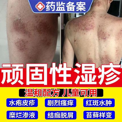 湿疹专用后背皮肤去止痒根喷剂湿膏沐浴露腹股沟腿痒小腿干燥JW