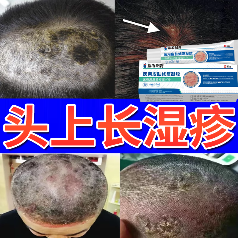 头癣克星去头皮屑癣药膏头皮藓专用洗发水头皮银结痂屑牛皮藓OZ