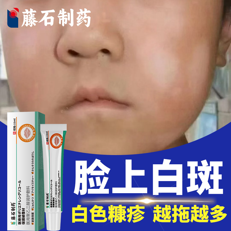 藤石制药】儿童白色糠疹皮肤修复