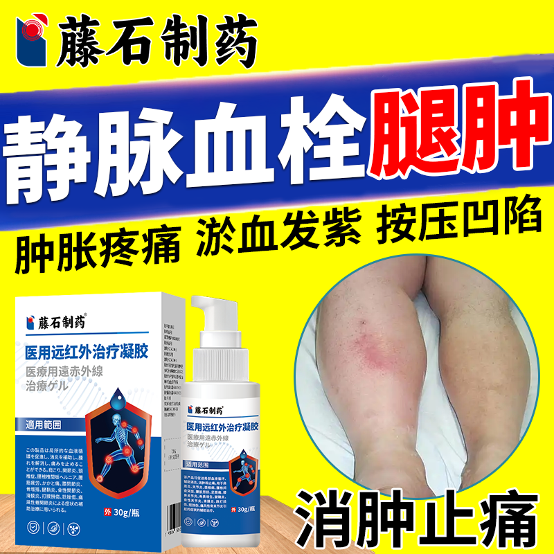 下肢深静脉血栓浮肿吃什么肿胀防小腿肿丘栓扩张后遗症的膏药贴OZ