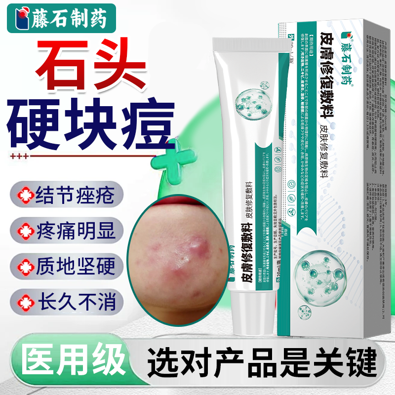 祛石头痘结节痘下巴反复长痘痤疮膏可搭红肿硬块痘痘贴痘痘催熟OZ