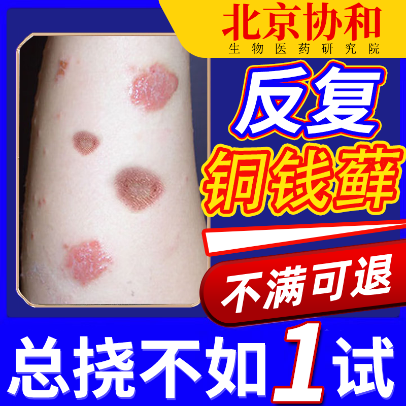 铜钱癣去体癣专用皮肤癣真菌感染正品杀金钱癣菌铜园藓薬膏bsd