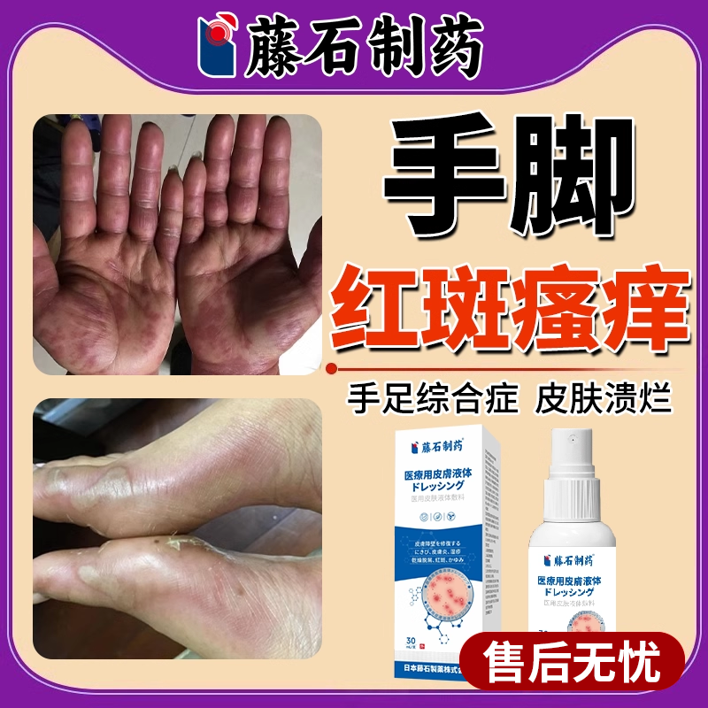 手足综合症征霜靶向用药房同款副作用靶肤皮肤抗菌液红斑疼喷剂EM