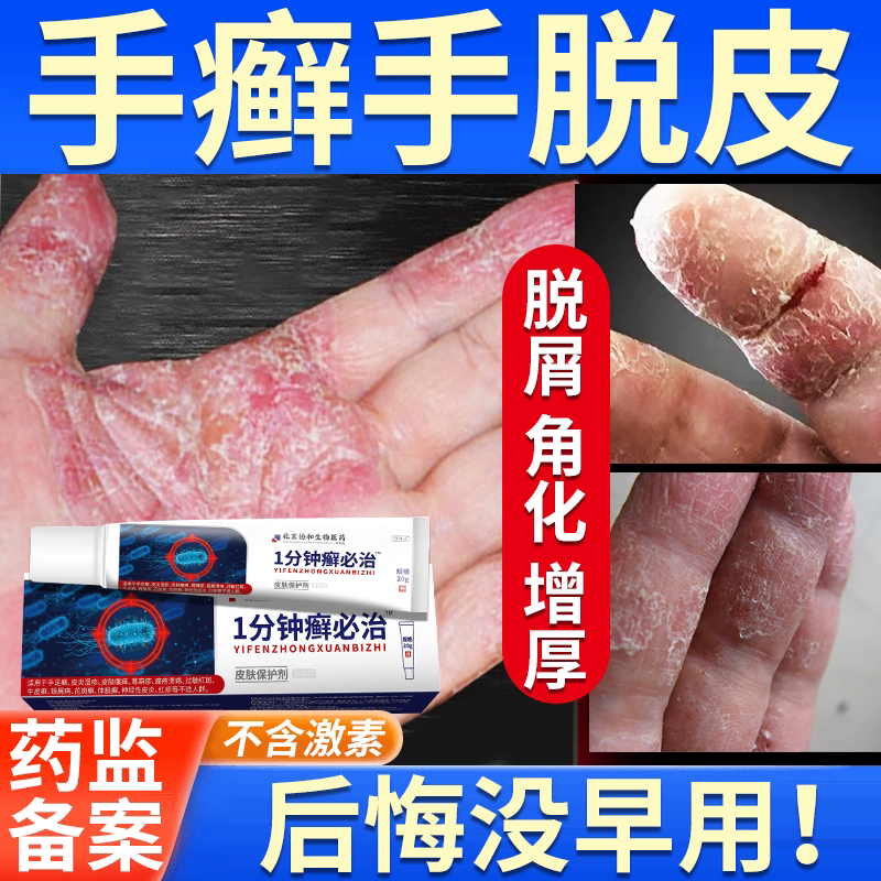 手癣膏脱皮干裂真菌感染湿疹去止痒根烂手鹅掌风手藓手足癣药膏jw
