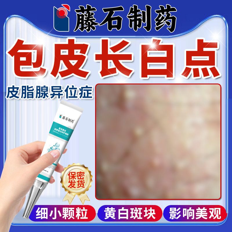 生殖器皮脂腺异位症阴茎包皮有小疙瘩阴囊白色白点脂肪颗粒水泡OZ