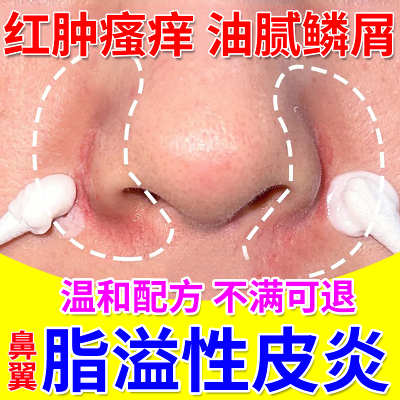 【温和配方】脸上脂溢性皮炎专用