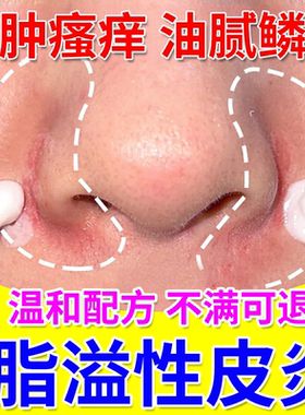 鼻翼脂溢性皮炎面部面霜软膏鼻子两侧发红脸上皮肤干燥起皮脱皮JW
