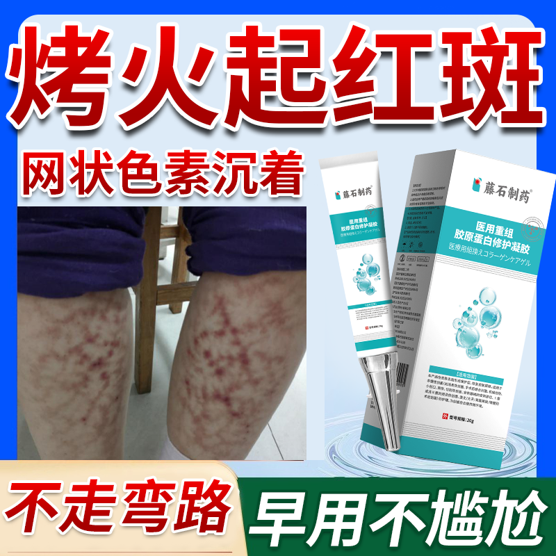 烤火后火激红斑去祛火斑腿上长红斑低温烫伤烤伤修复药房同款膏OZ