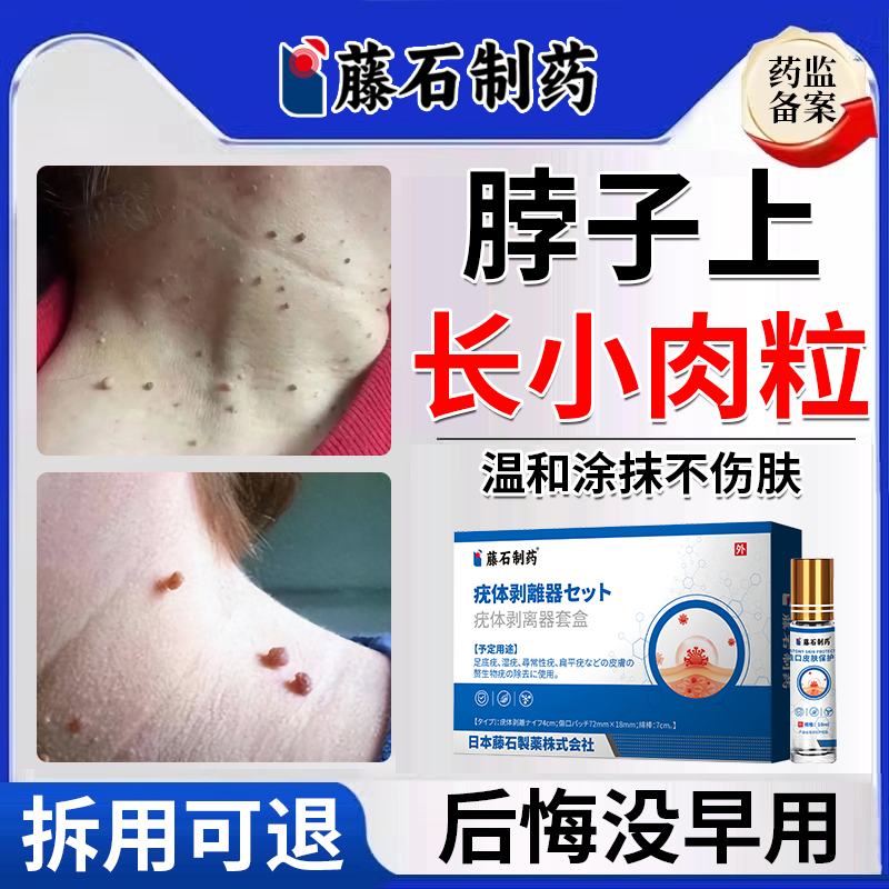 【医用级】脖子上长小肉粒疙瘩