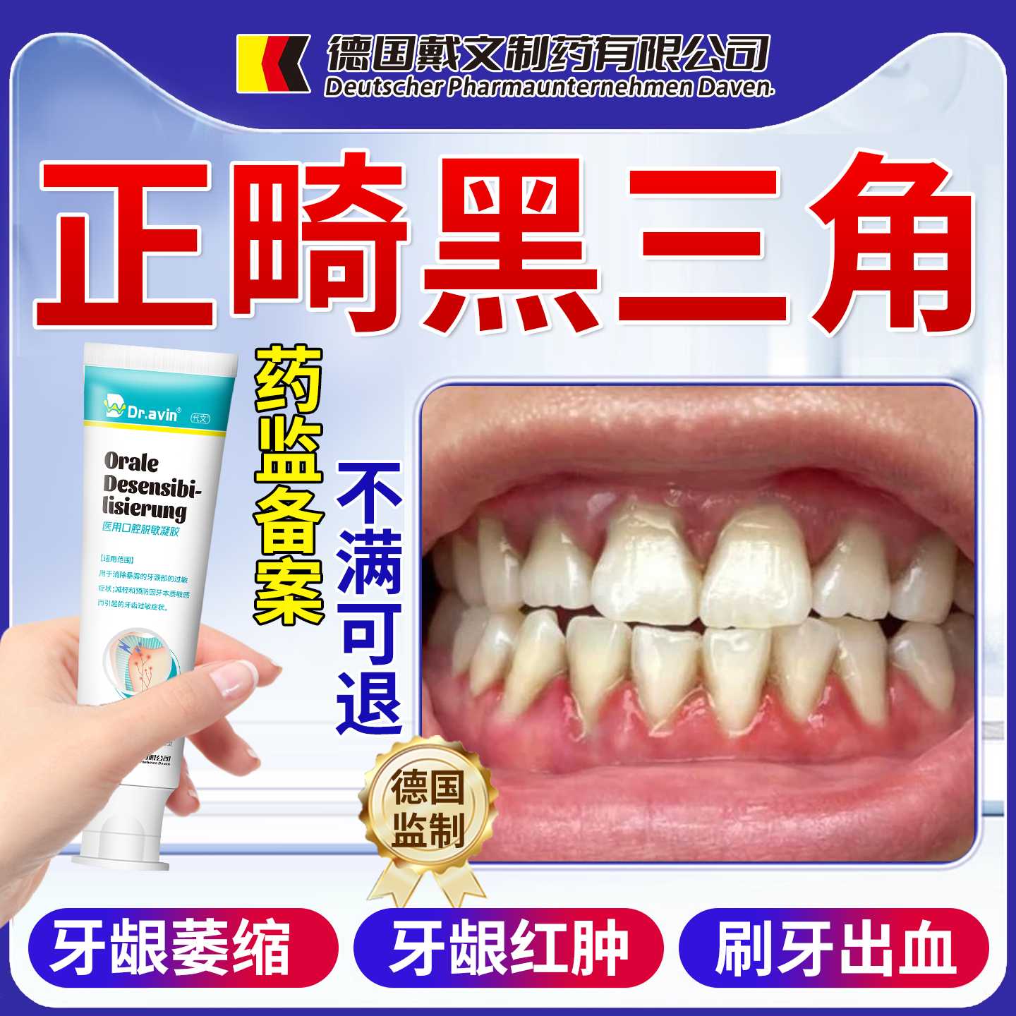 【医用级】正畸引起牙龈黑三角