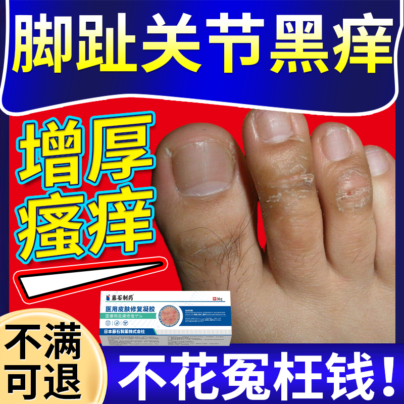 脚趾关节黑痒湿疹膏发黑瘙痒增厚