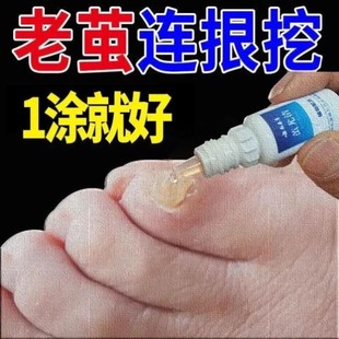 去脚底老茧死皮茧子膏祛除脚茧软化剂清茧灵硬皮专用神器手脚垫