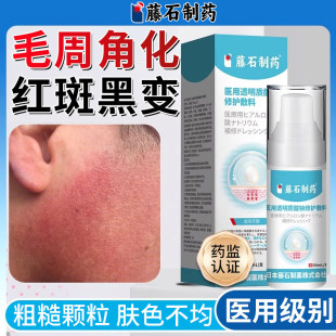 面部毛囊红斑黑变病脸颊两边小疙瘩鸡皮肤毛囊毛周角化症儿童HT