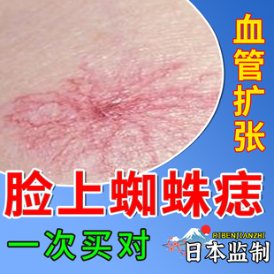 蜘蛛痣去血管瘤痣除涂抹膏面部专用凝胶毛细血管扩张点痣无痕去SC