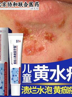 黄水疮药房同款膏脓包疮传染性丘疹水疱脓胞溃烂糜烂黄色结痂LG