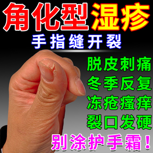 指甲缝手指尖开裂脱皮冬角化型手部湿疹手癣膏脱皮干裂真菌感染KV