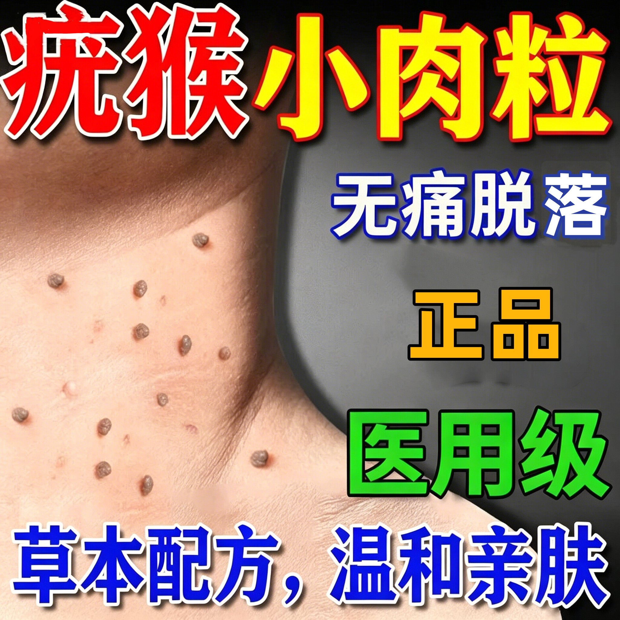 去肉痣皮赘扁平疣瘊子去除膏颈部脖子长小肉粒疙瘩腋下丝状疣肉球