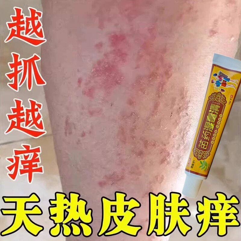 夏天小腿痒湿成人止痒膏出汗身上痒天热皮肤瘙痒热疙瘩红疹热毒