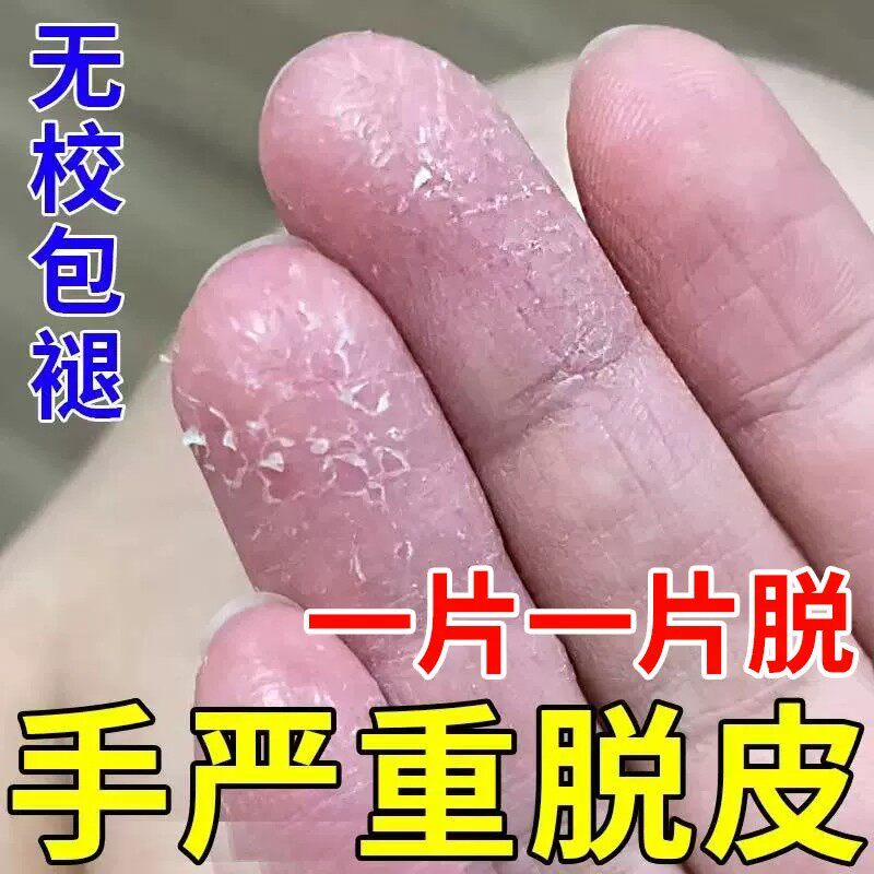 手足脱皮膏手指上真菌蜕皮干燥起皮童手掌蜕皮手心手脚掉皮褪专用