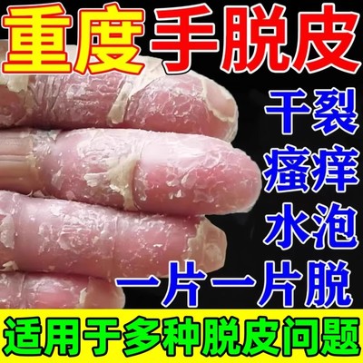 手足脱皮膏手指上真菌蜕皮干燥起皮童手掌蜕皮手心手脚掉皮褪专用