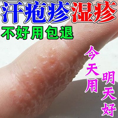手上起小水泡汗状泡疹止痒汉状感染手上长水泡痒脱皮干裂专用