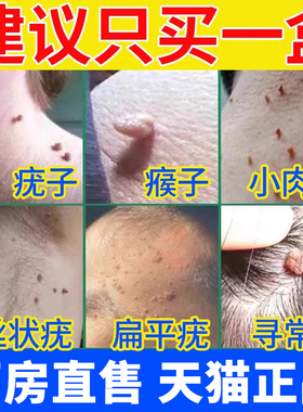 云南本草克尤膏去除疣瘊平肉粒鸡眼扁平专用丝状一抹无忧趾疣净膏