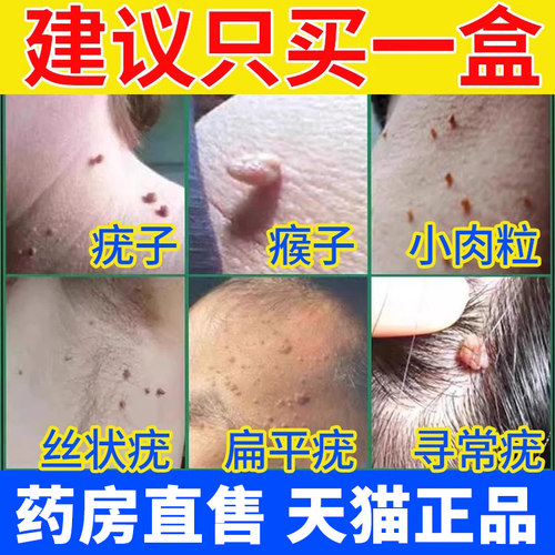 本草克尤膏去除疣瘊平肉粒