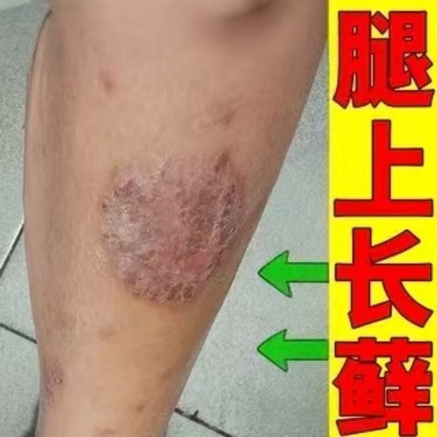 牛藓王乳膏【当天告别皮肤问题】