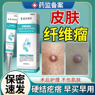 皮肤纤维瘤去除消瘤药膏肿块皮下硬小疙瘩结节肉瘤可搭去除神器OZ