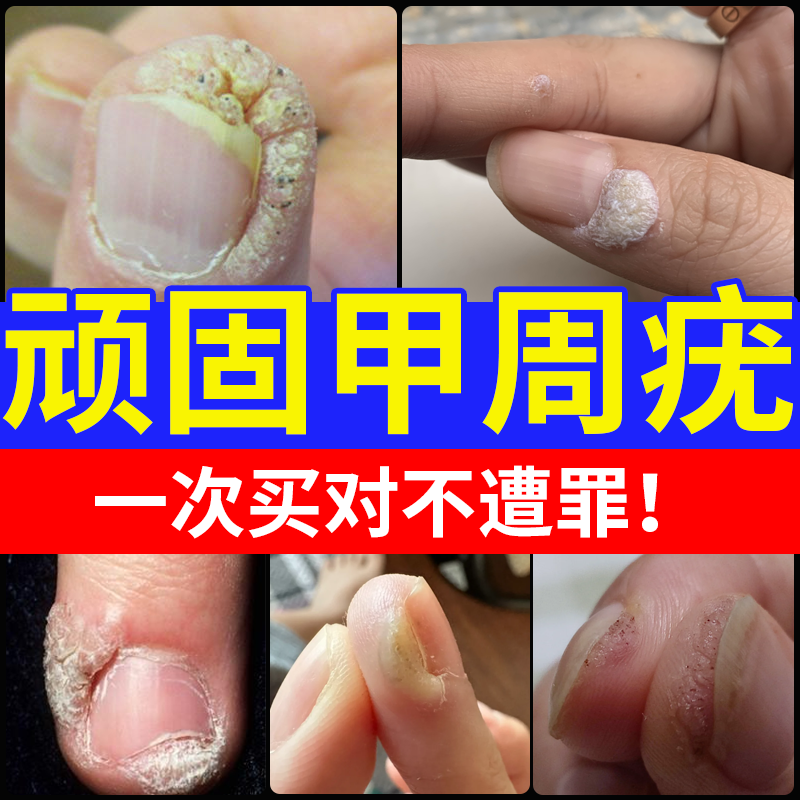 甲周疣甲下专用指手上长疣寻常疣去除神器儿童祛疣灵薬房同款膏jw