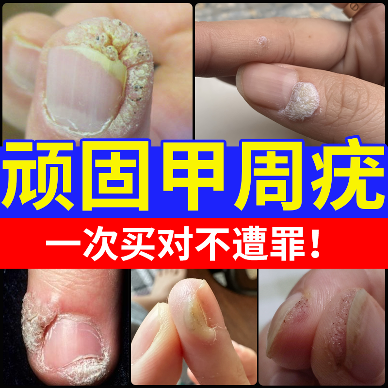 【结痂脱落】甲周疣专用膏