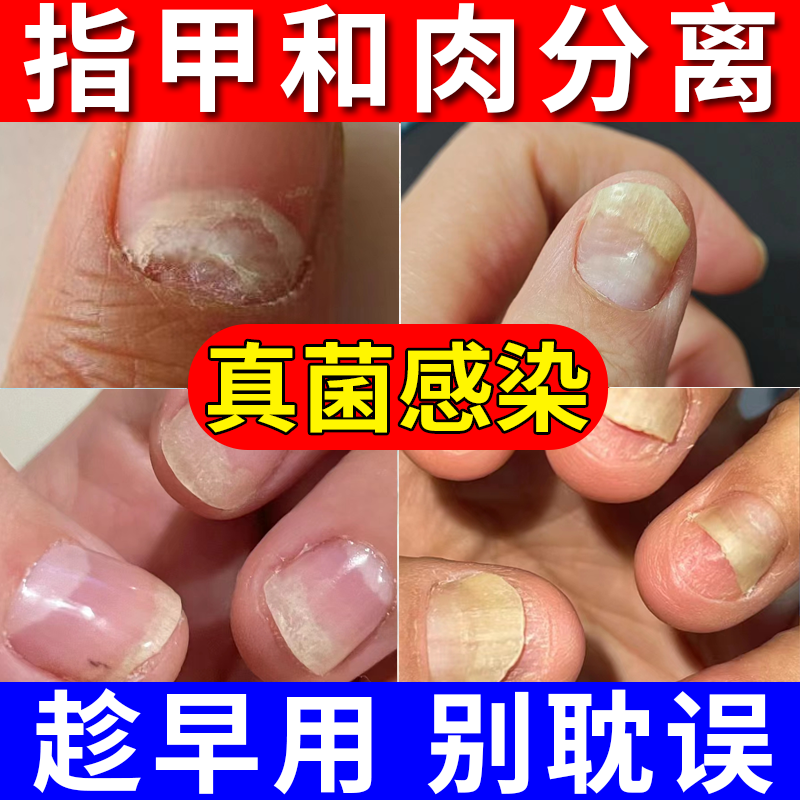 空甲手指甲受损甲肉分离专用真菌感染甲床空指甲薬房同款修复液JW