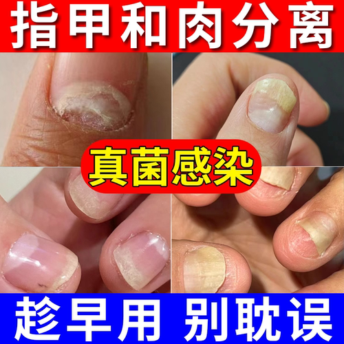 【医用正品】空甲真菌感染专用液