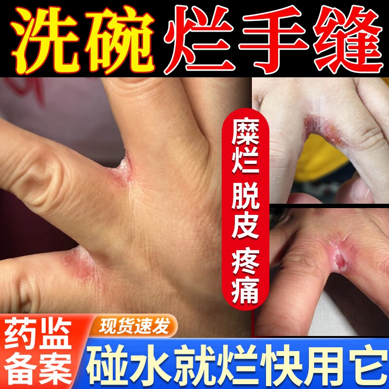 洗碗手指缝溃烂痒脱皮长期泡水专治湿疹烂手丫专用软膏药房同款JW