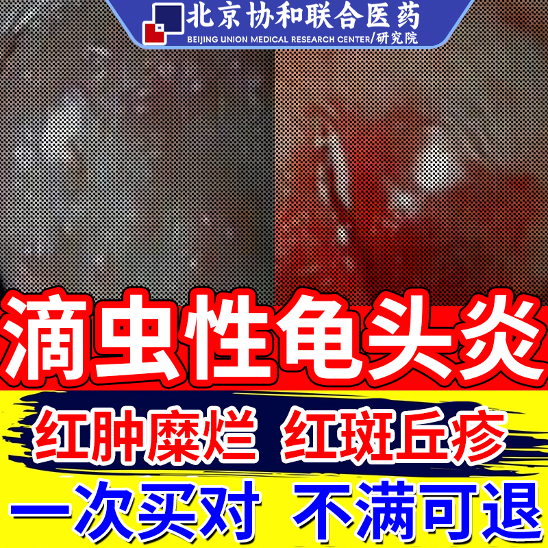 男性滴虫性龟头炎专用真菌感染小红点瘙痒霉菌清洗液薬房同款膏em
