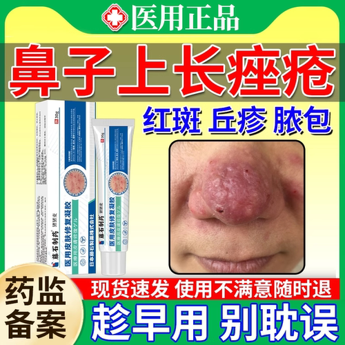 酒渣鼻酒糟鼻玫瑰痤疮红鼻子软膏专用可搭配去红血丝膏药贴用JW