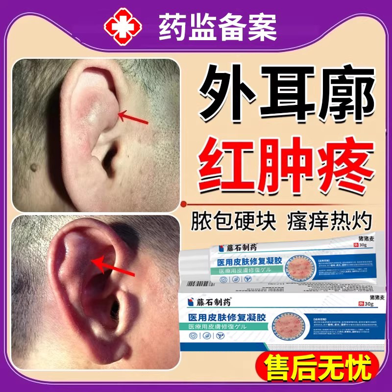 外耳廓假性囊肿夹子耳朵疖肿胀有硬块肿瘤皮脂腺消软骨膜炎增生EM